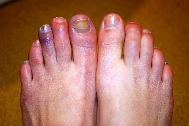 Chilblains
